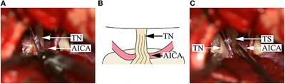 Delayed pain relief in patients with trigeminal neuralgia following microvascular decompression: A single-central retrospective study